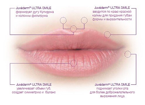 Для такой косметической коррекции, как увеличение губ, Ювидерм считается идеальным препаратом, применение которого ведет к ожидаемому результату.-2