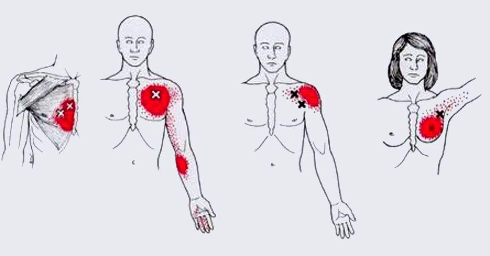 Мышечная грудная боль. Триггерные точки грудинная части большой грудной мышцы. Триггерные точки в грудной мышце. Триггерные точки грудной клетки. Триггерные точки в верхней части тела.