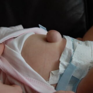 Пупочная грыжа определяется как округлое или овальное выпячивание различной величины в околопупочной области, которое можно заметить при беспокойстве и плаче ребенка и с легкостью вправляется при надавливании пальцами.