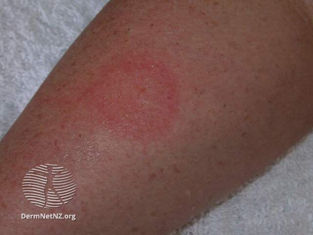 Мы видим красное пятно (фото из dermnetnz.org)