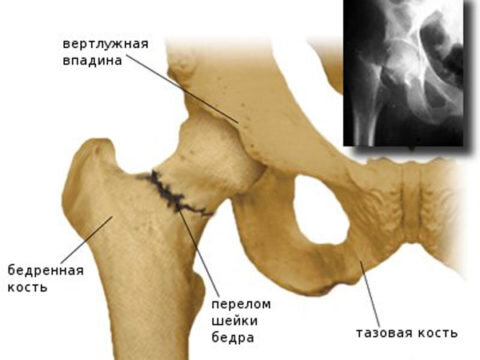   К восстановительному периоду после операции на шейке бедра нужно  подходить с большой серьезностью – это поможет избежать ряда осложнений.