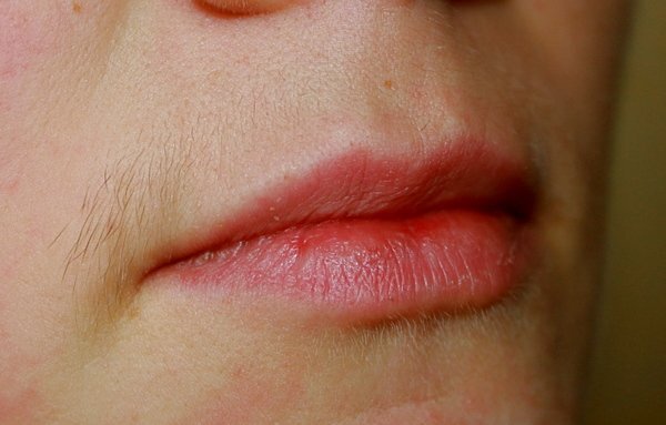    Многим женщинам знакома проблема оволосенения на лице, в частности в области над верхней губой. Смотрится это нелепо и не эстетично, особенно если волоски темного цвета, вызывают комплексы.