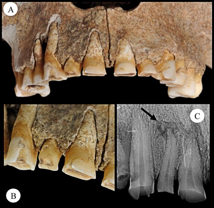 Износ зубов и поражение костей. (Micarelli et al.)