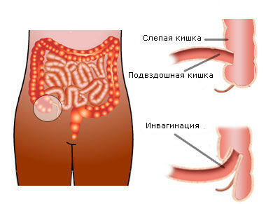 Инвагинация - Педиатрия - Справочник MSD Профессиональная версия