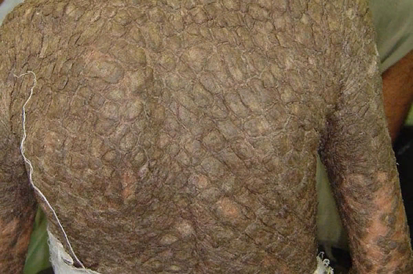 Так болезнь выглядит со спины 