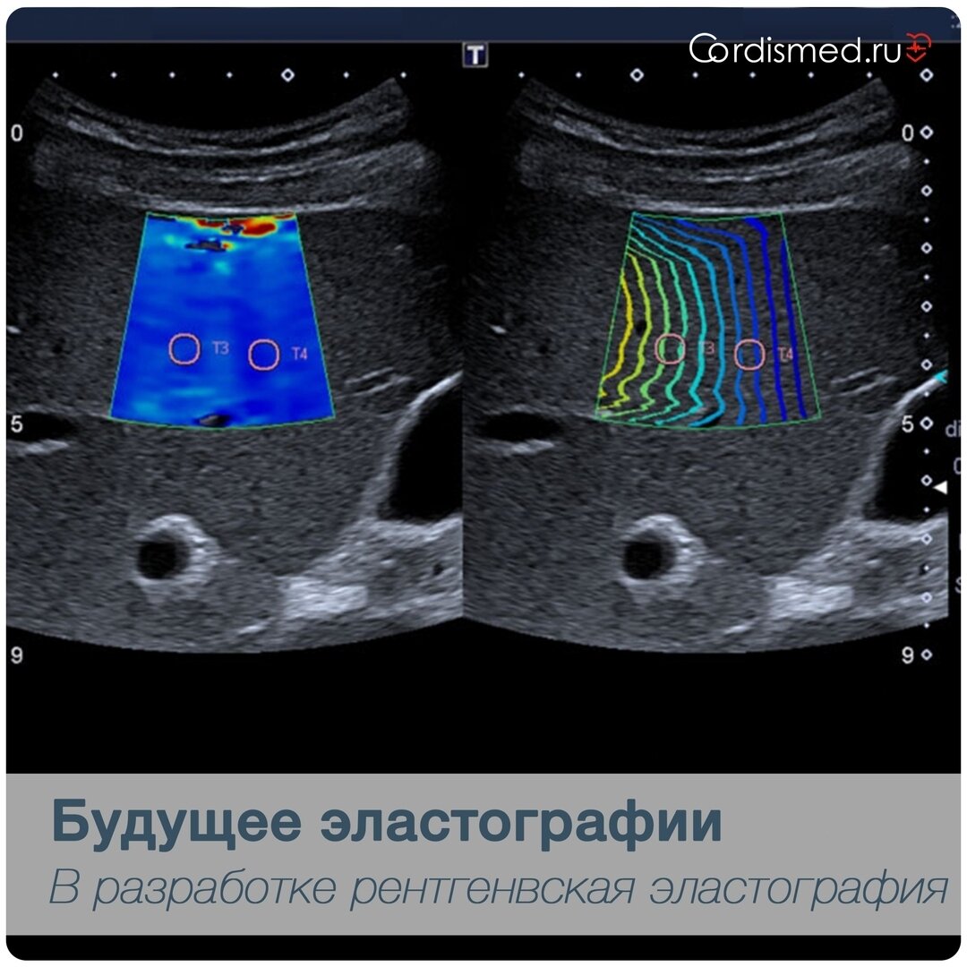 Компрессионная эластография печени