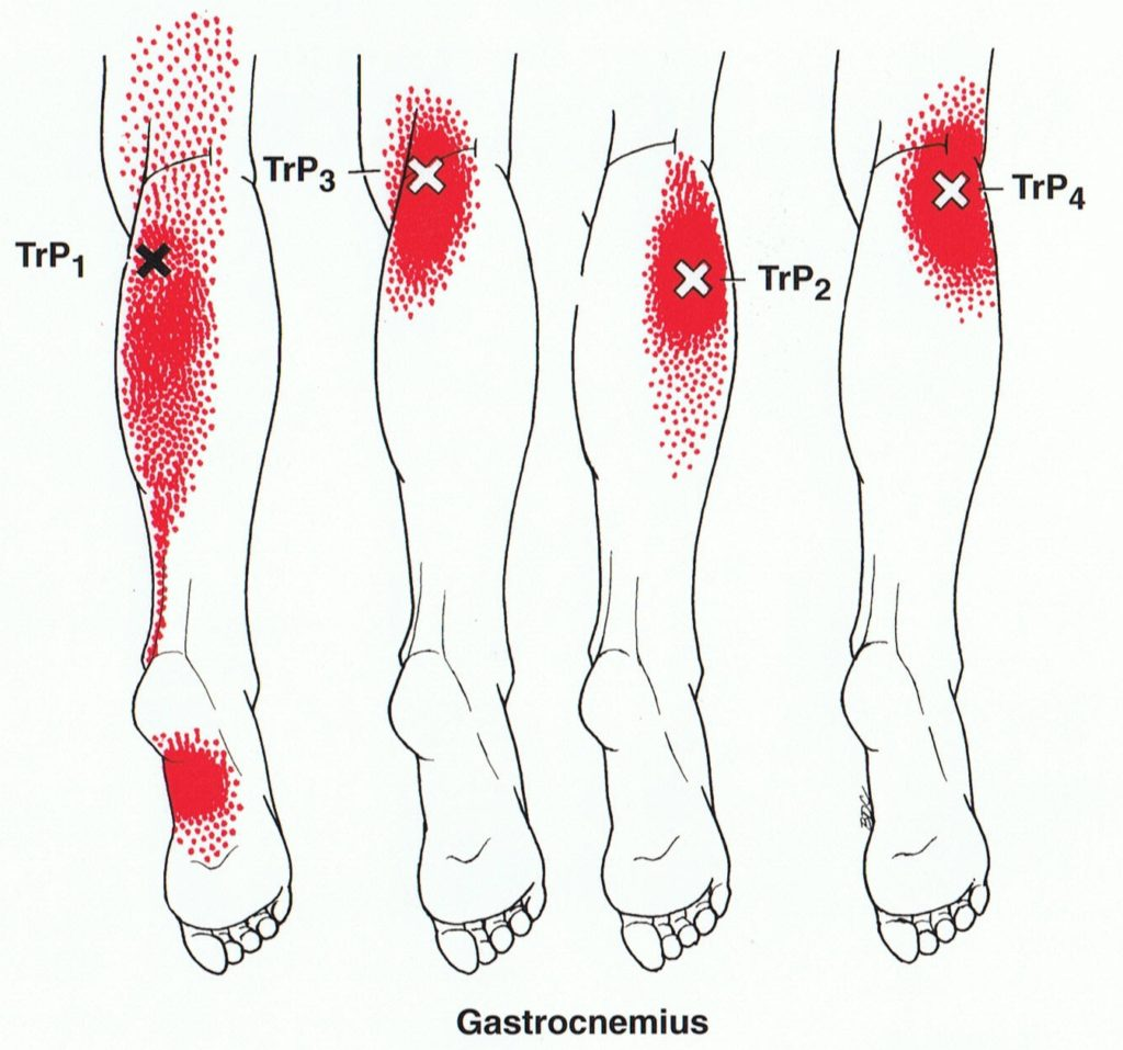 Точка на голени ноги. Триггерные точки мышц голени. Триггерные точки икроножной мышцы. Карта точек боли в теле и точек напряжения мышц триггеры. Миофасциальный синдром стопы.