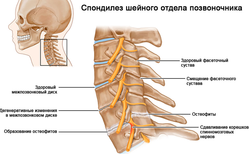 Спондилез шейного отдела позвоночника. Спондилёз шейного отдела симптомы. Спондилёз шейного отдела позвоночника что это такое. Деформирующий спондилез с 6 - с 7. Спондилез спондилоартроз шейного отдела позвоночника.