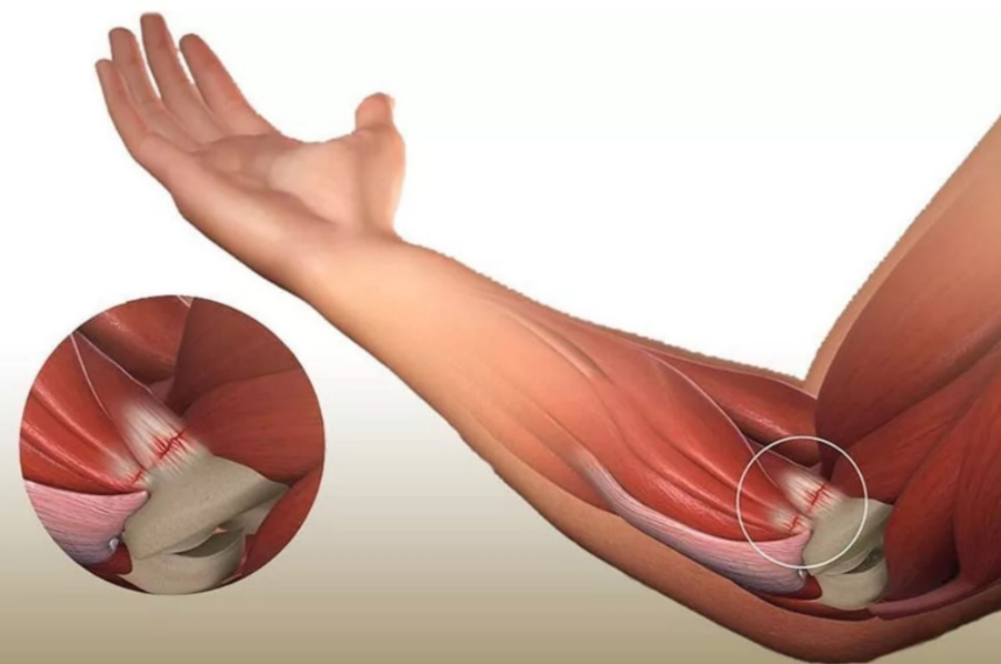 Эпикондилит локтевого. Латеральный эпикондилит локтевого. Эпикандилитлоктекого сустава. Медиальный эпикондилит локтевого. Латеральный эпикондилит сухожилие.