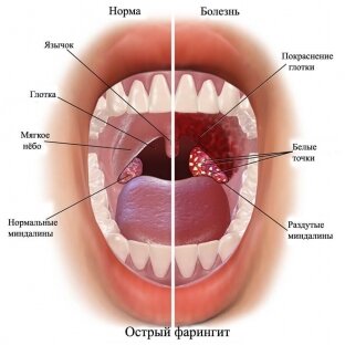 ПРОЯВЛЕНИЯ ВИЧ В ПОЛОСТИ РТА