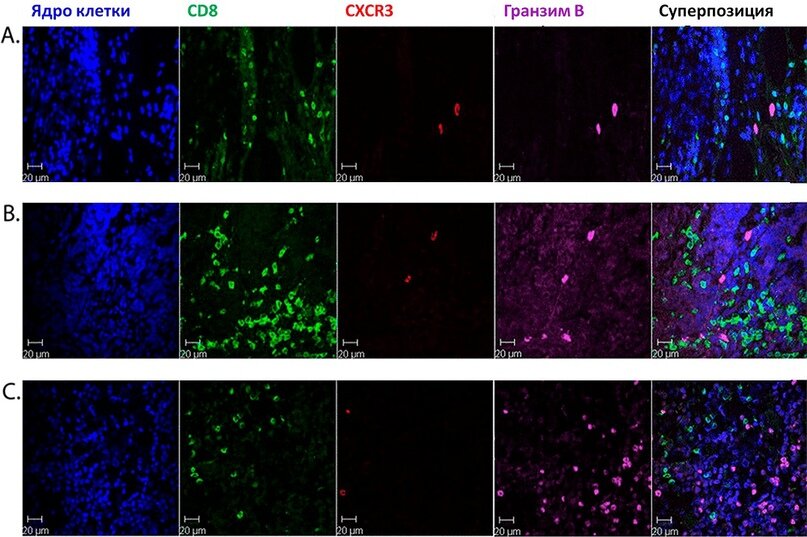Окрашивание четырех ассоциированных с Т-лимфоцитами маркеров в ткани карциномы из клеток Меркеля при помощи флуоресцентно меченных антител. CD8 — рецептор на поверхности Т-киллеров; CXCR3 — хемокин, экспонируемый в первую очередь на активированных Т-лимфоцитах; гранзим Б — важнейший белок, участвующий в процессе контактного цитолиза. По этому изображению можно судить, что в опухолевой ткани есть Т-лимфоциты, способные уничтожить опухоль методом контактного цитолиза. 