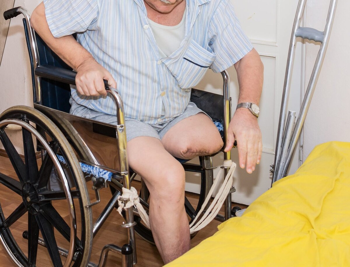Инвалидность после ампутации ноги