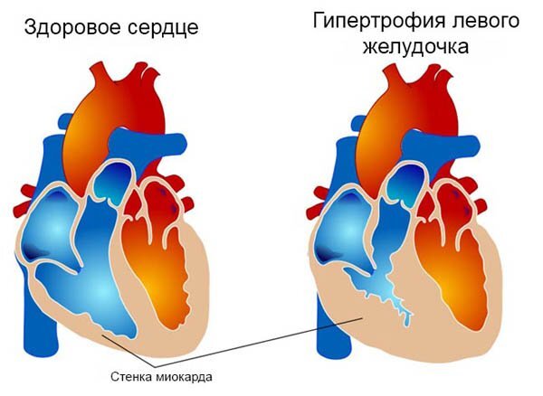 Брадикардия сердца - что это, причины, симптомы и лечение