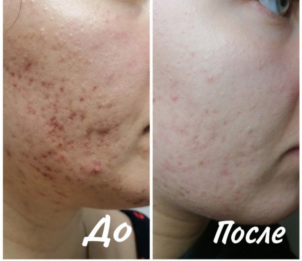 Устранение акне