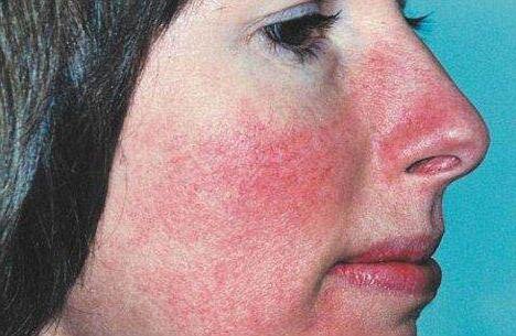 Розацея, акне, крапивница, купероз - болезни кожи, возрастные. Проявления блашинг-синдрома с виду идентичным указанным ранее болезням...