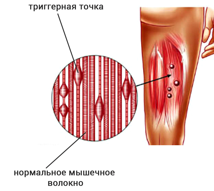 Триггерные точки шея голова