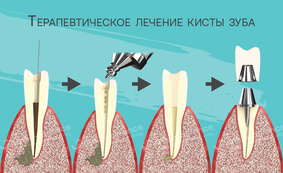 Киста зуба – лечение или удаление? Можно ли вылечить кисту на корне зуба без удаления?