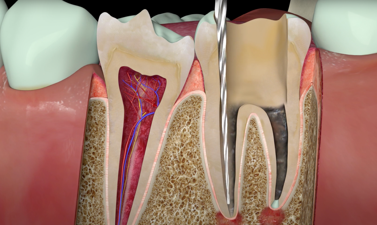 Очистка каналов поврежденного кариесом зуба. Фото https://implantolog-fedorov.ru/