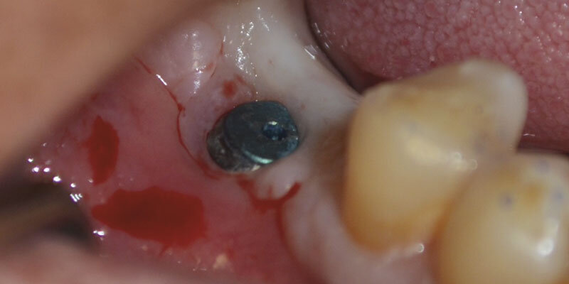 Рисунок 1: 1,5 месяца после установки имплантата
