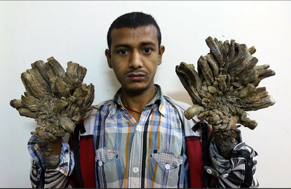 Tree man. Верруциформная эпидермодисплазия. Бородавчатая эпидермодисплазия (болезнь Левандовского-Лютца).. Человек дерево деде Косвара