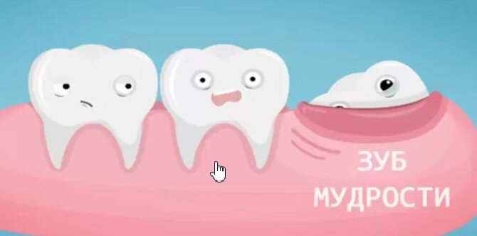 Зубы мудрости прорезываются в возрасте от 17 до 27 лет. С особенностями этого процесса сталкивается практически каждый человек. «Восьмерки» ничем не отличаются от других многокорневых зубов.-3