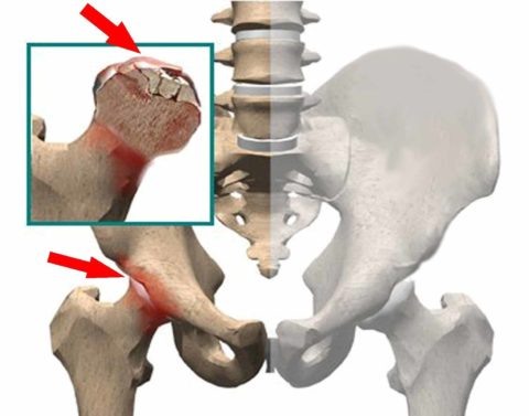  Асептический некроз развивается вследствие отмирания костных тканей из-за нарушения их трофики и кровоснабжения.