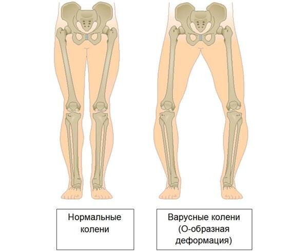 Варусная деформация стопы у детей. Как лечить?