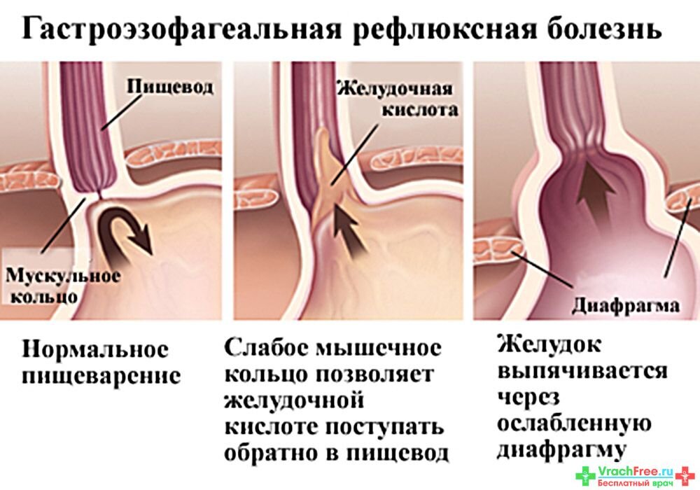 Как снять спазм пищевода при рефлюксе быстро
