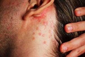 В результате дерматита нарастают мертвые клетки. По этой причине за ухом появляется бугорок. Обычно патология сопутствуется шелушением кожного покрова, отечностью, покраснением и воспалительным процессом. Шишка начинает болеть. Себорейный дерматит – это часто встречающаяся форма дерматита, которая провоцирует появление шишки за ухом. Особенно это касается людей, больных эпилепсией или СПИДом.