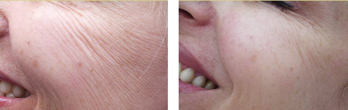 фото до и после