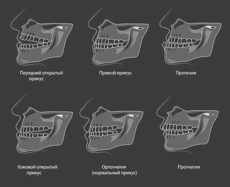 Правильный прикус у человека схема фото
