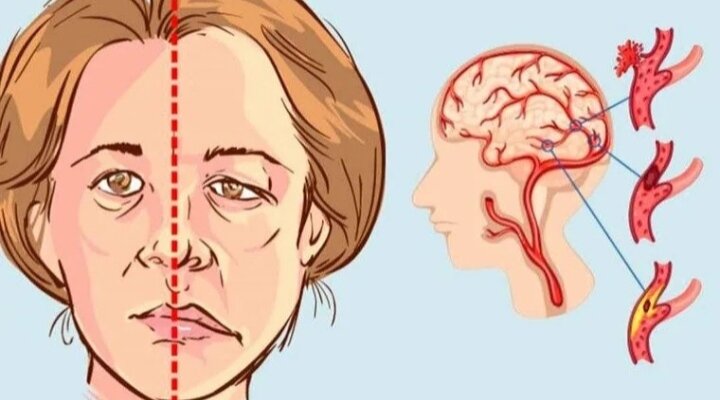 Изменения черт лица во время инсульта