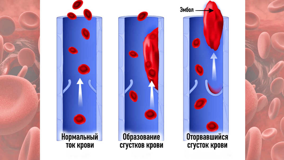 Как нарисовать тромб