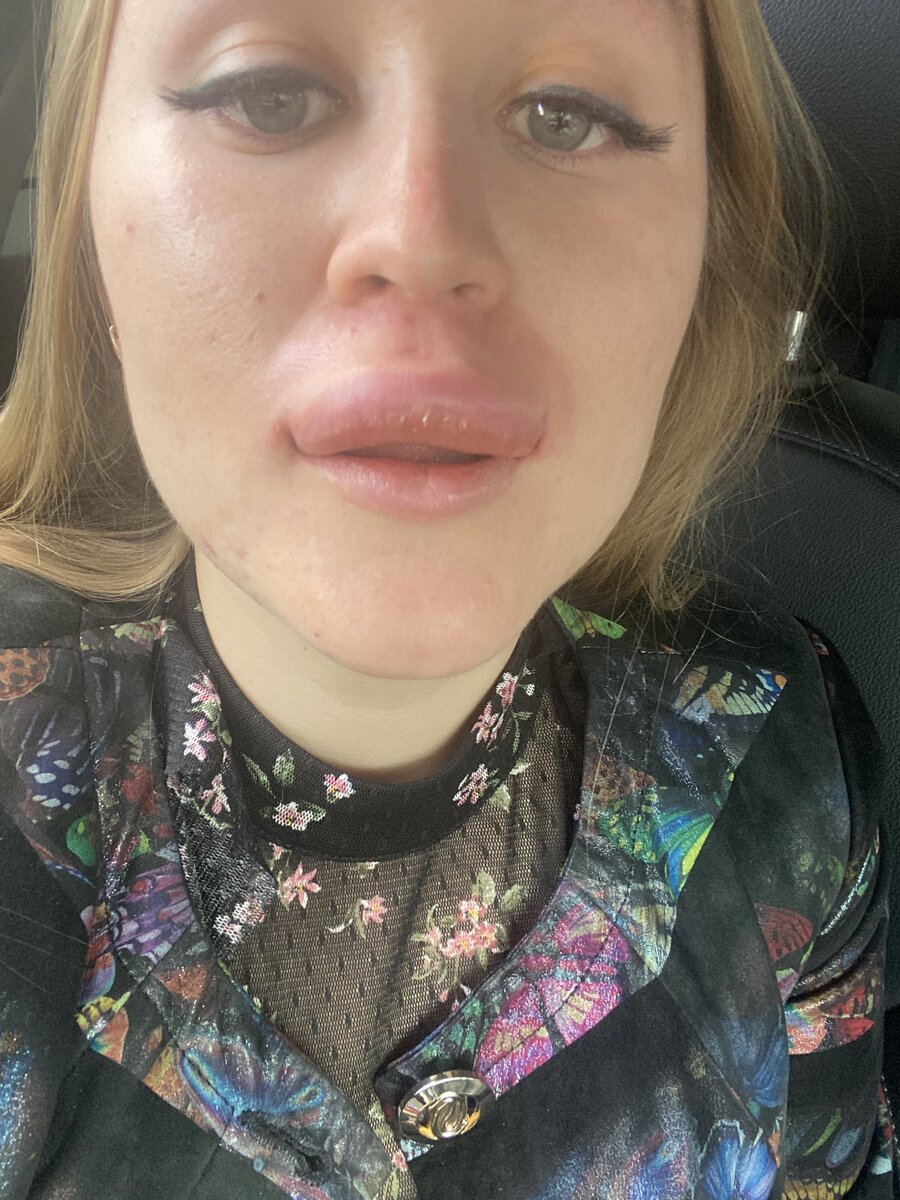 Отек после лонгидазы