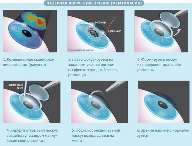 При каком зрении нельзя делать коррекцию. Лазерная рефракционная кератопластика (методом Femto super LASIK). Ласик схема операции. Фемто ласик этапы операции.