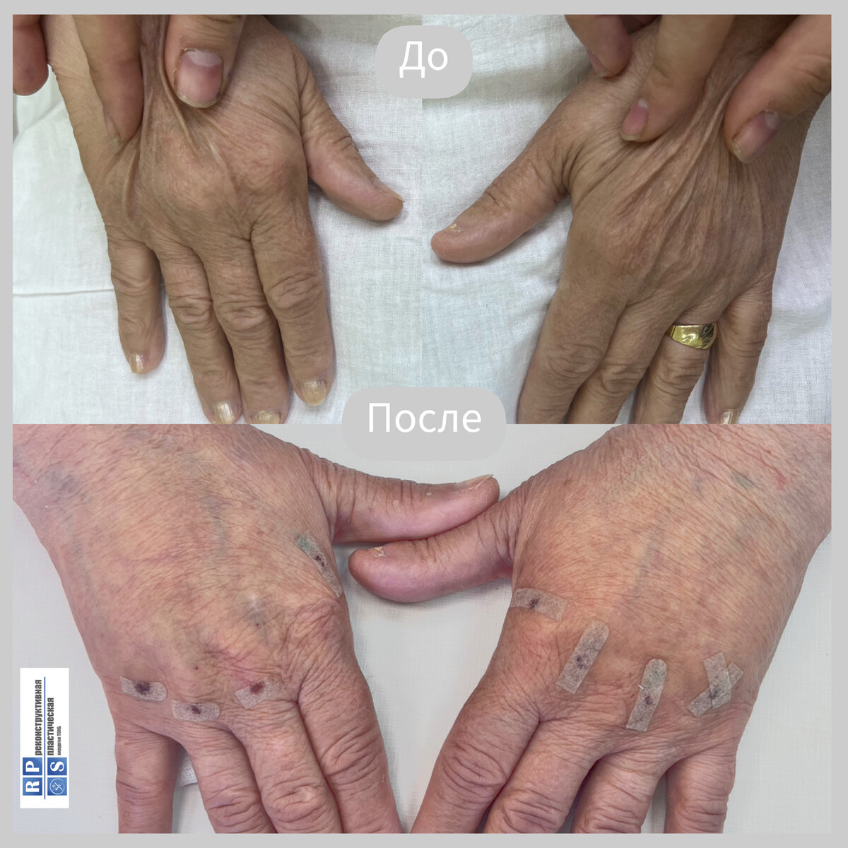 Результат операции, выполненной пластическим хирургом Раши Тимуром Романовичем