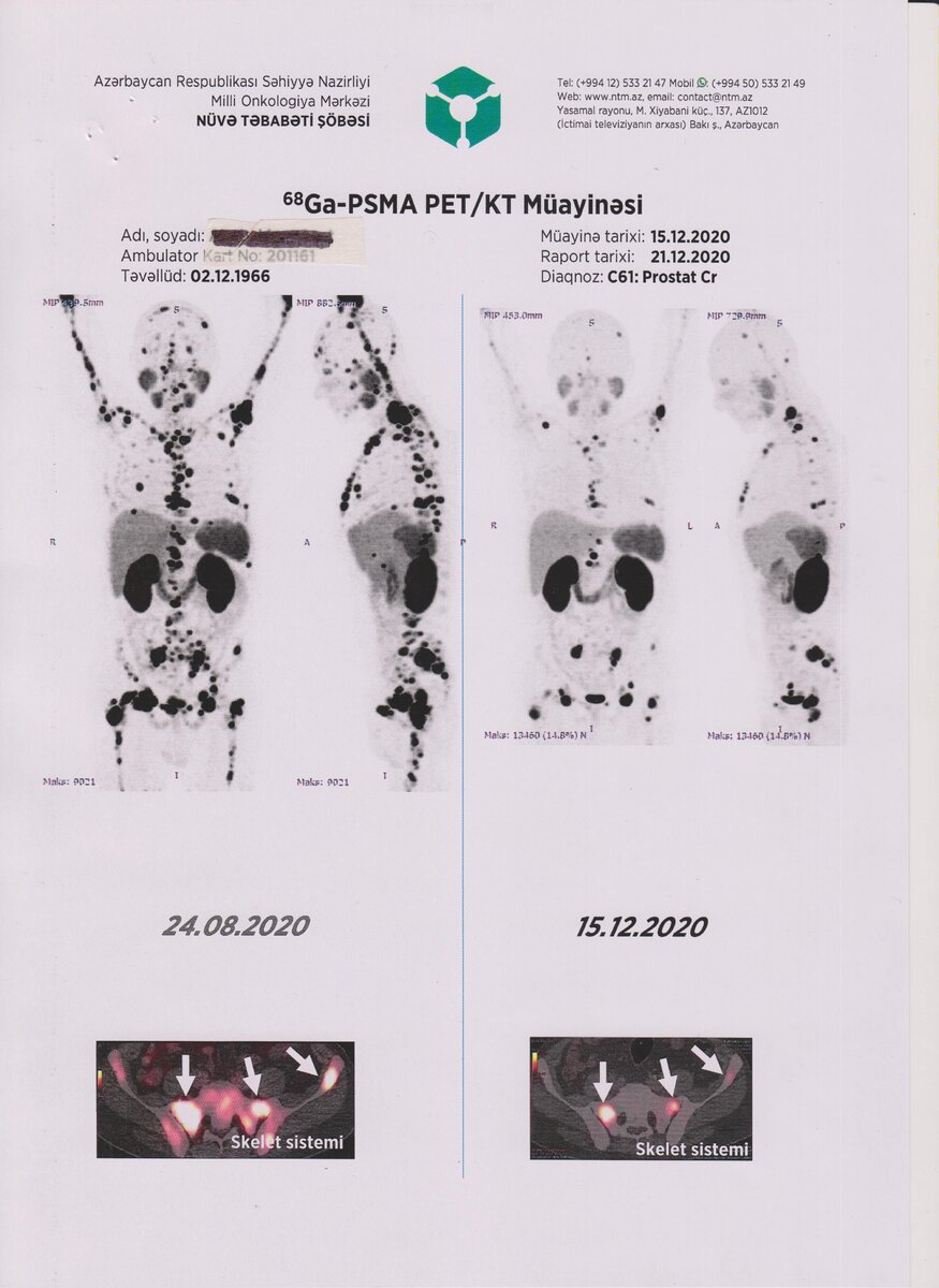 Галерея из трех фотографий автора. Динамика результатов ПЭТ-КТ исследований с PSMA-617, меченого изотопом 68Ga, в сравнение. До начала лечения в августе и перед вторым курсом в декабре прошлого года.