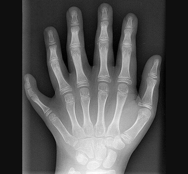 Рентгеновский снимок шестипалой левой руки 10-летнего ребёнка. (Creative Commons https://en.wikipedia.org/wiki/File:Polydactyly_01_Lhand_AP.jpg)