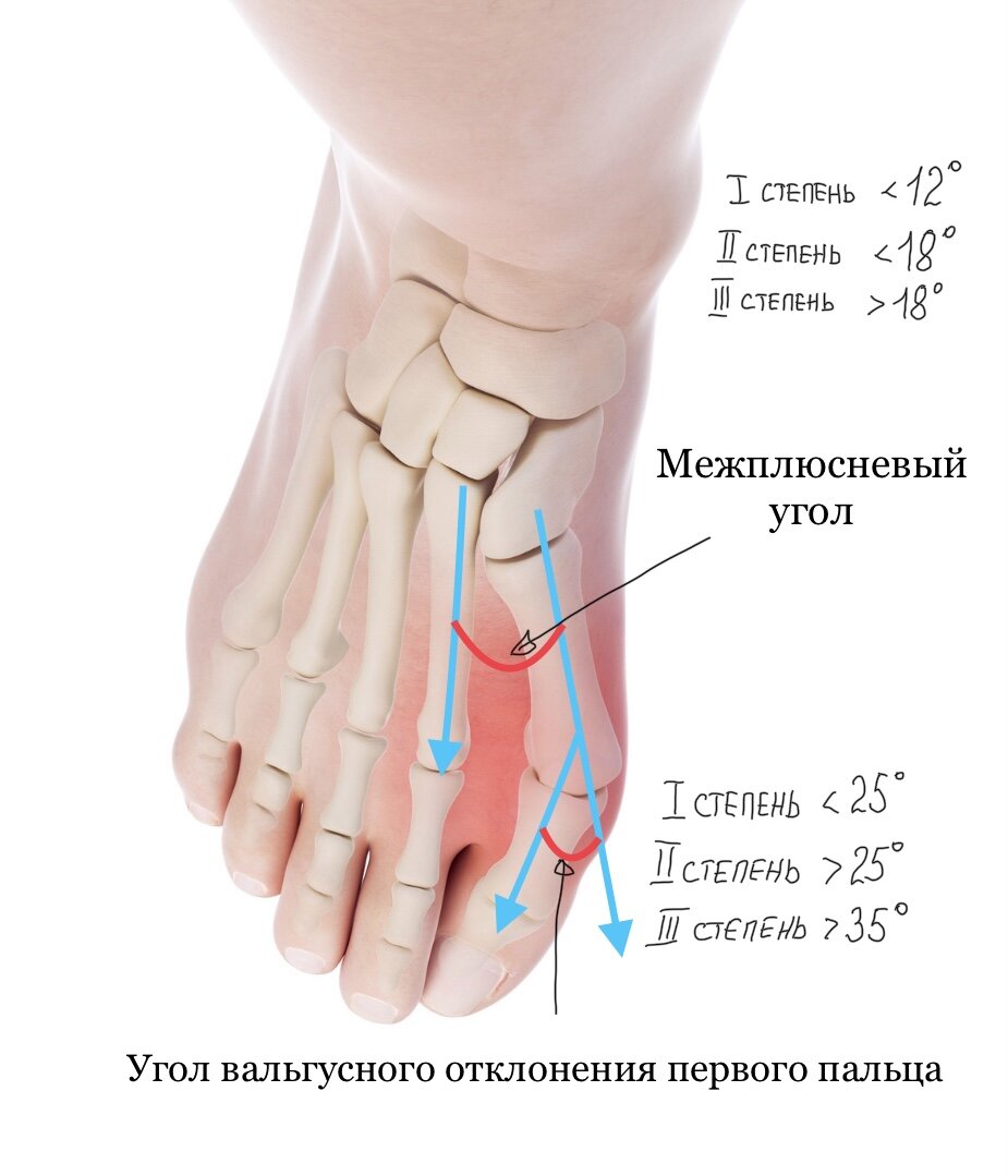 Косточка на пальце