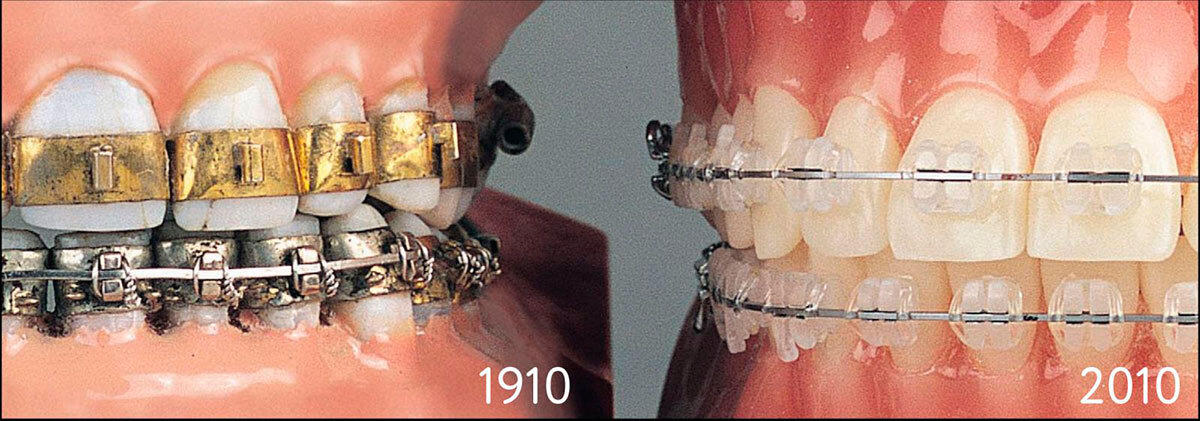 История появления брекетов