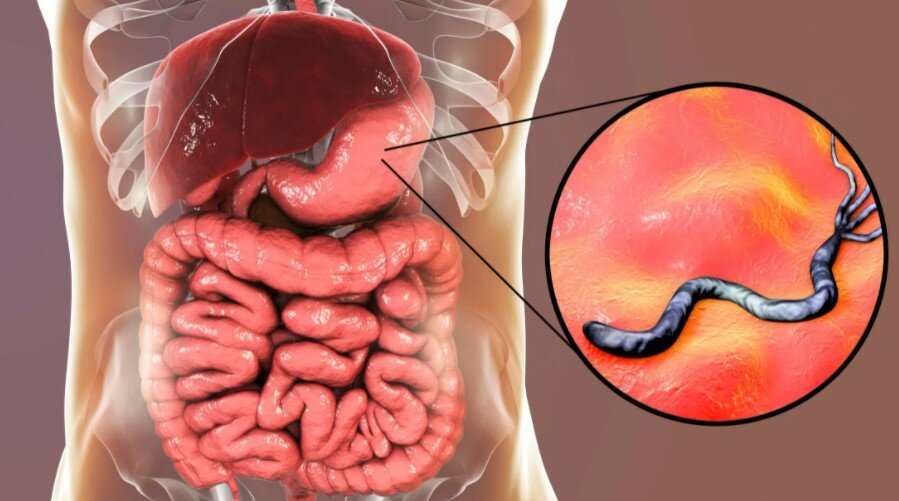 Что надо делать, чтобы не заразиться Helicobacter pylori?