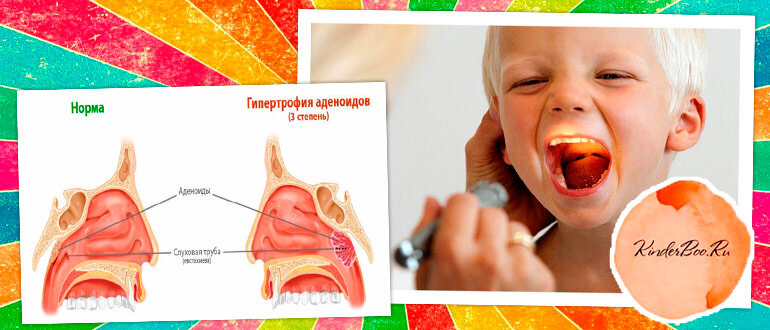 источник: https://svetly3.ru/800/600/https/kinderboo.ru/wp-content/uploads/2019/01/adenoidy-u-detey.jpg