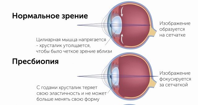 Пресбиопия: возрастная дальнозоркость