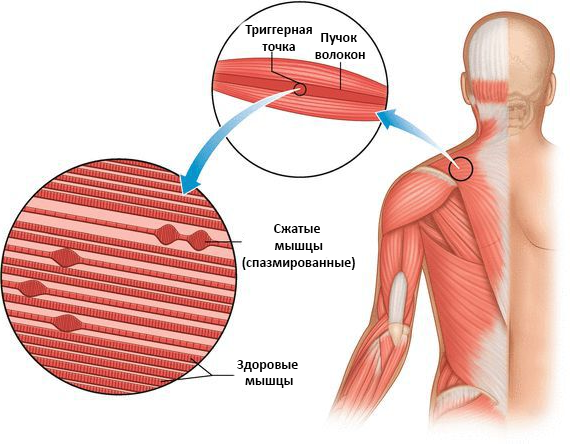 Вот триггерная точка и как она выглядит под микроскопом
