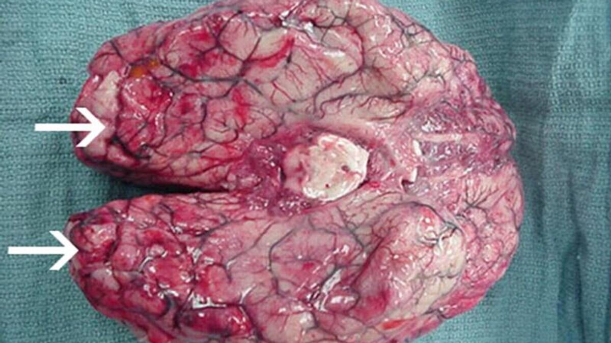    Мозг, пораженный амебой Naegleria fowleri© CDC