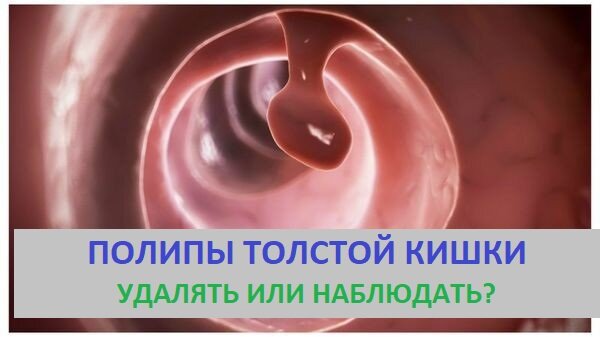 Полипы толстой кишки. Удалять или наблюдать? | Доктор Силантьева | Дзен