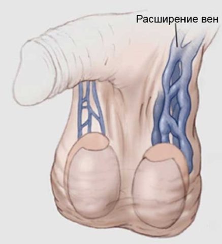 Варикоцеле