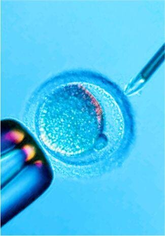 Экстракорпоральное  оплодотворение сегодня считается одной из самых высокотехнологичных  методик для борьбы с бесплодием. 