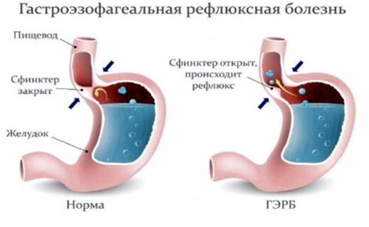 Часто возникает кашель из-за рефлюкса. Это заболевание является следствием нарушения деятельности мышцы, призванной поставлять пищу в желудок. Снимается надежная блокировка и желудочная кислота выплескивается в пищевод.
 
 Это вызывает поражение слизистых покровов дыхательных путей, приводящее к появлению сухого кашля.
 Среди факторов, вызывающих ГЭРБ - гастроэзофагеальную рефлюксную болезнь, отмечаются следующие патологические состояния организма: