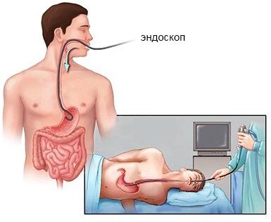 Язвенная болезнь желудка и 12-перстной кишки